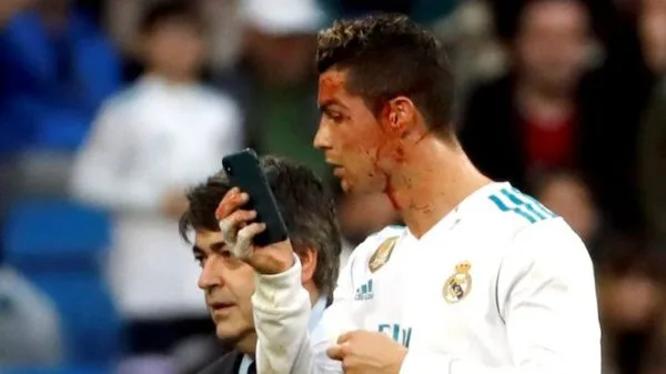 Cristiano Ronaldo scored twice but had to leave the pitch with his face covered in blood Cristiano Ronaldo scored twice but had to leave the pitch with his face covered in blood